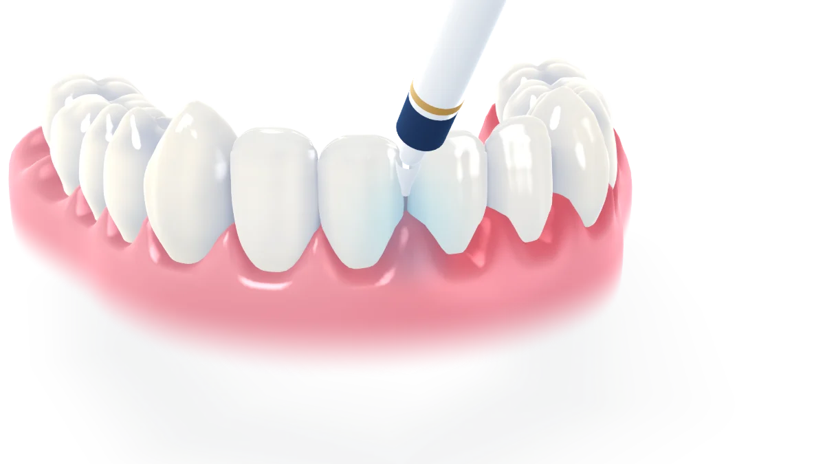 Perio laser: a soft laser light traces the gum line and the gum heals behind it, calm and pink