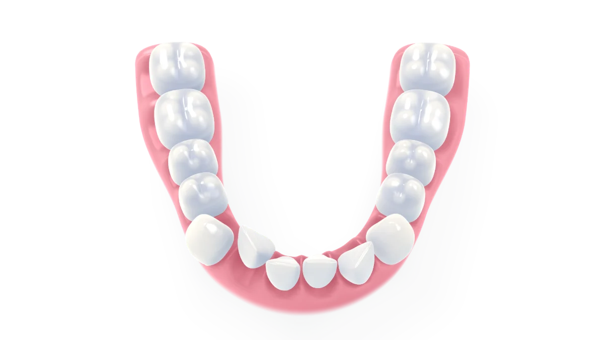 Seen from above, a crowded lower arch widens and its teeth turn and glide one by one into a perfect horseshoe