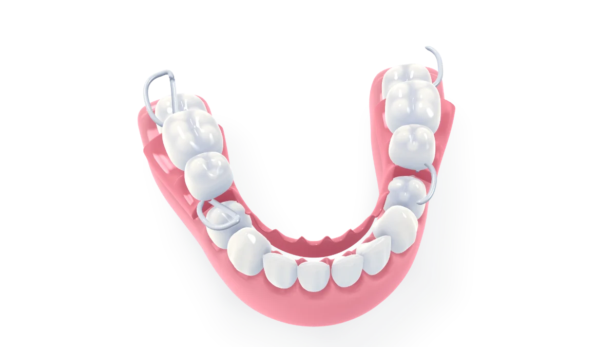 A partial acrylic denture: pink acrylic saddles with new teeth drop into the gaps of the lower arch and click home on fine wire clasps