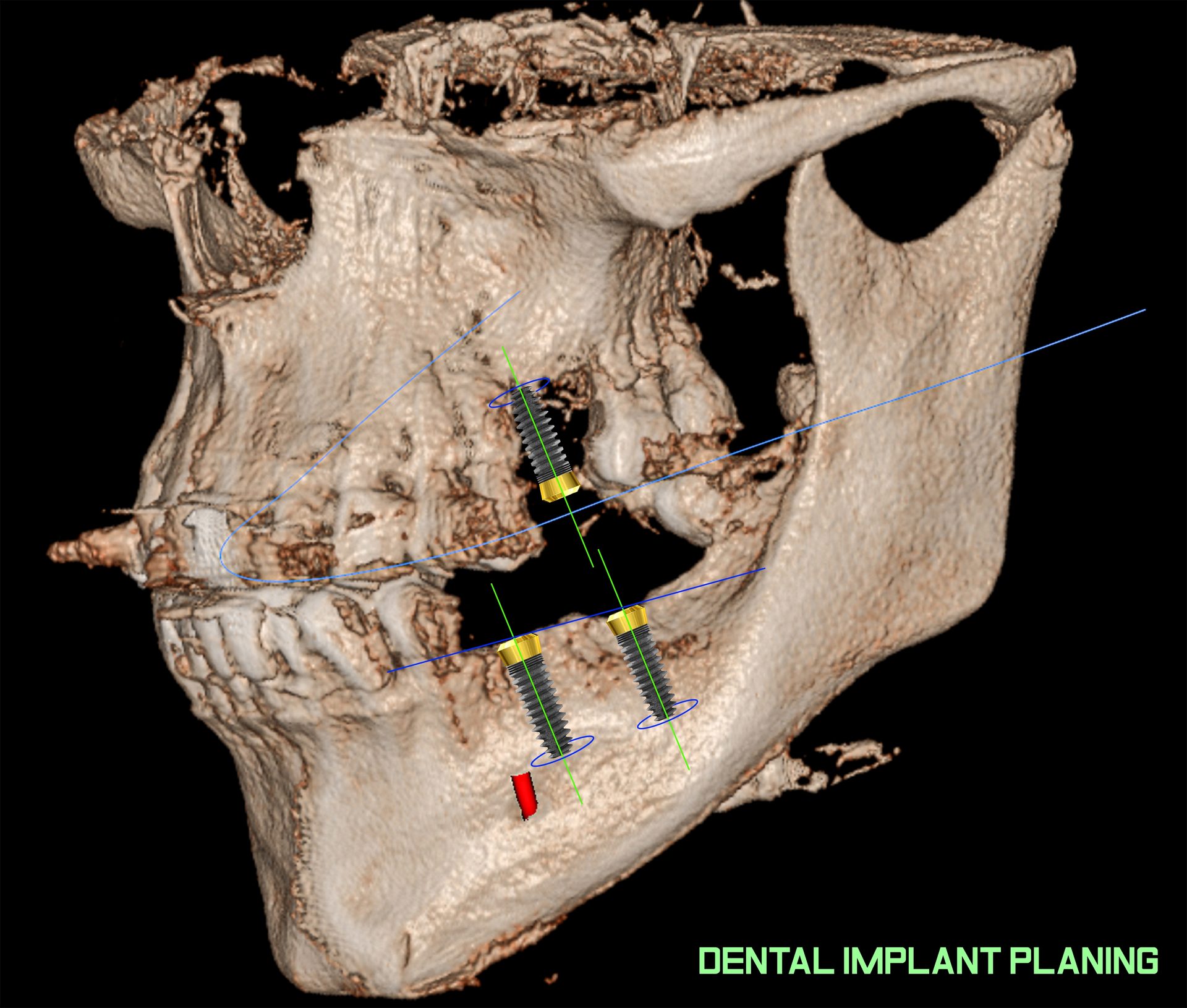 A full fixed arch on six implants for extra support