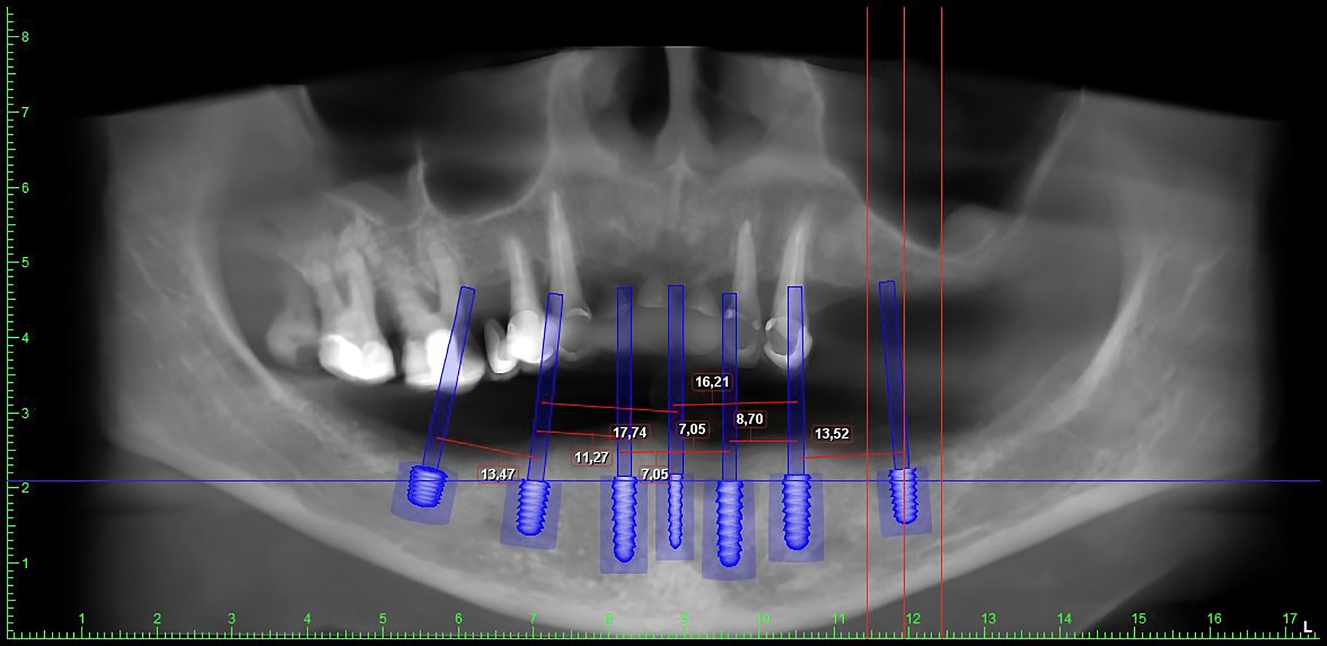How a dental implant is placed: the 7 steps explained