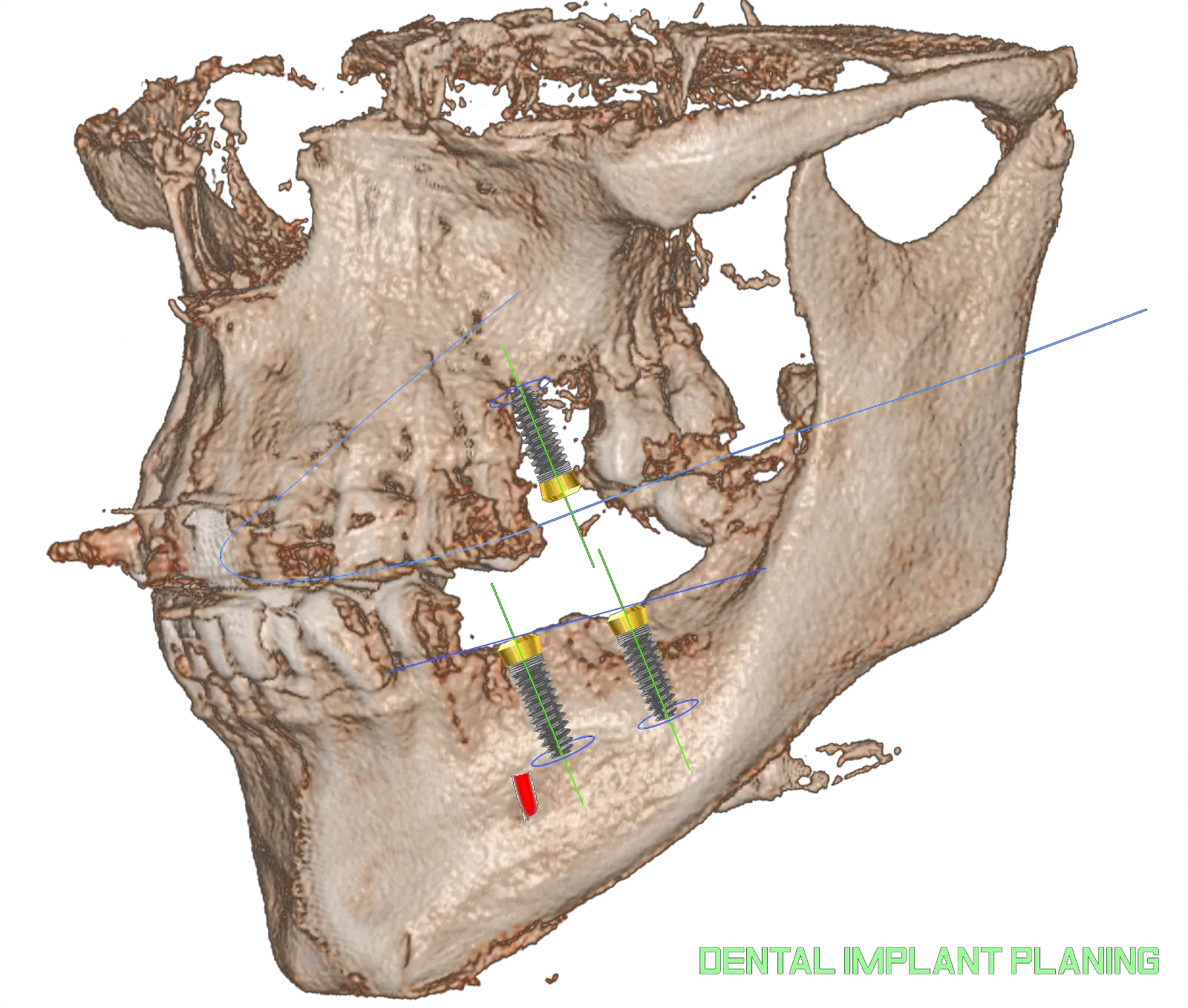 A dental implant planned on a 3D scan at Apex Dental